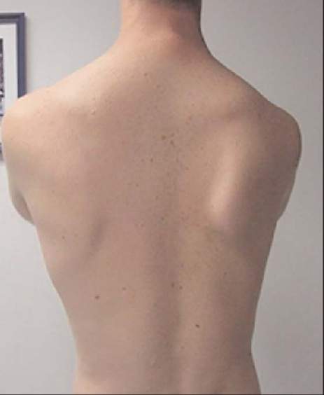 winged_scapula